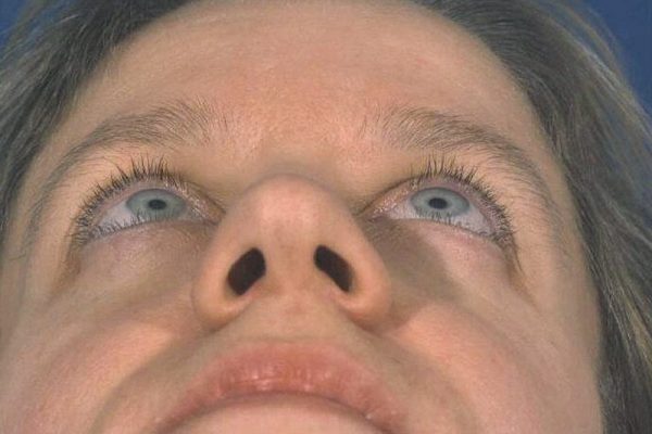 rhinoplasty-37