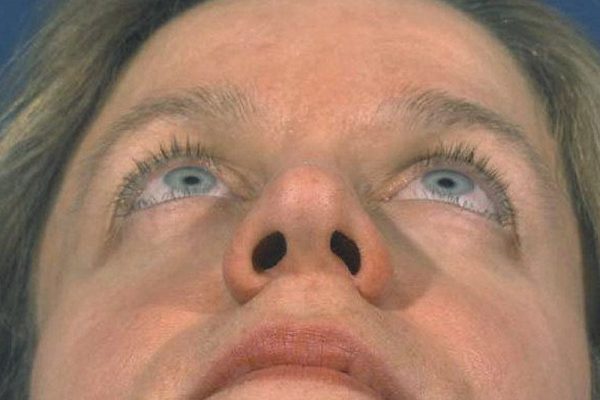 rhinoplasty-38