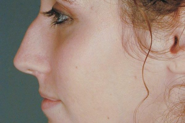 rhinoplasty-39