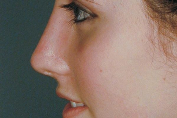 rhinoplasty-40