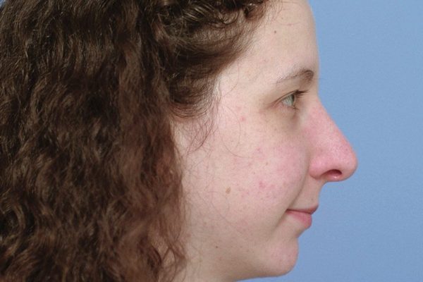 rhinoplasty-41