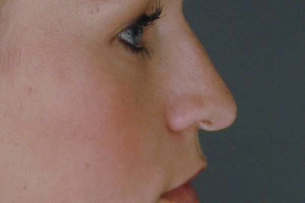 rhinoplasty-411