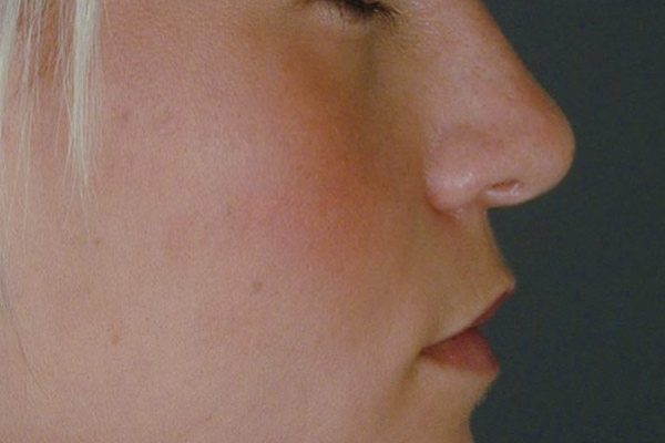 rhinoplasty-42