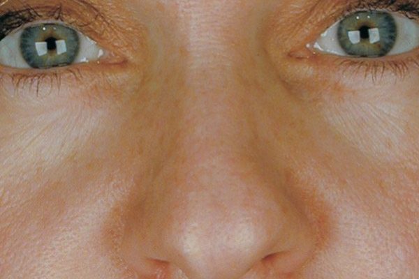 rhinoplasty-43