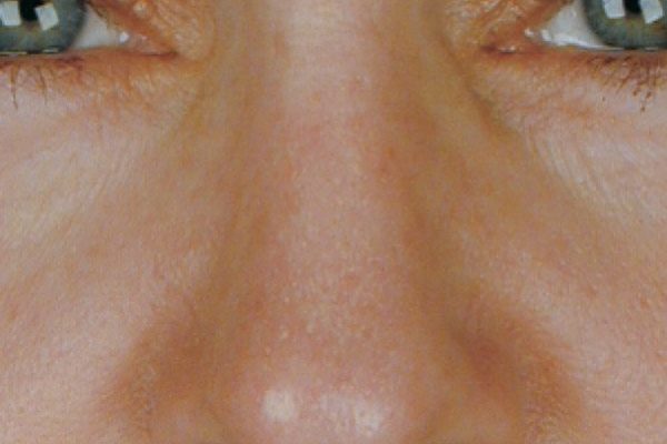 rhinoplasty-44