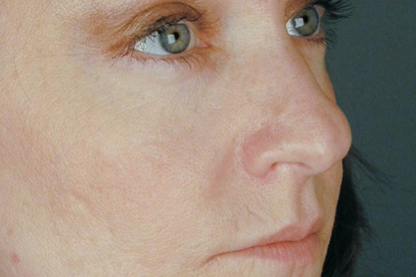 rhinoplasty-45