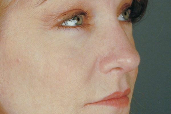 rhinoplasty-46