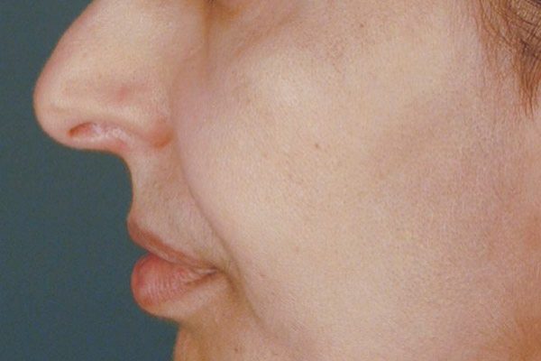 rhinoplasty-47