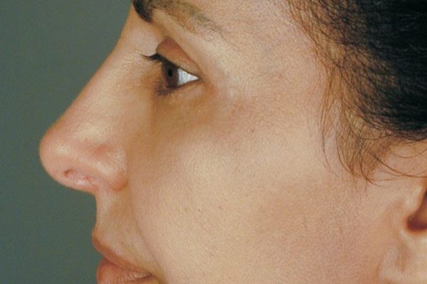rhinoplasty-48