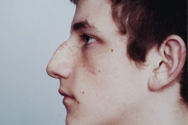 male rhinoplasty