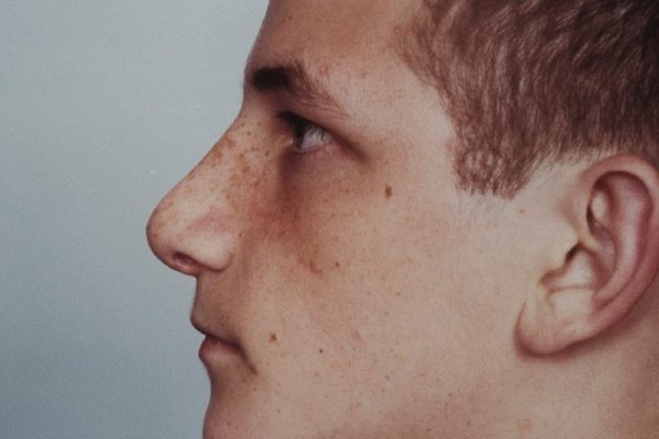 male rhinoplasty
