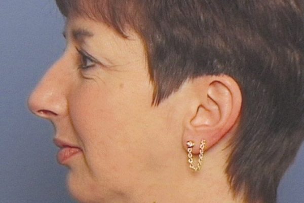 rhinoplasty-51