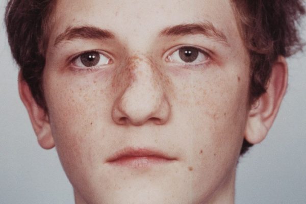 male nose rhinoplasty