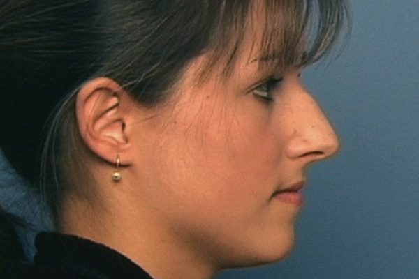rhinoplasty-53