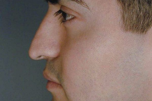 rhinoplasty-55