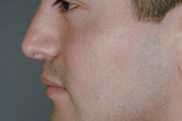 rhinoplasty-56