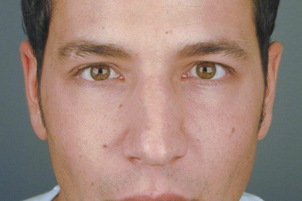 rhinoplasty-57