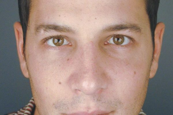 rhinoplasty-58