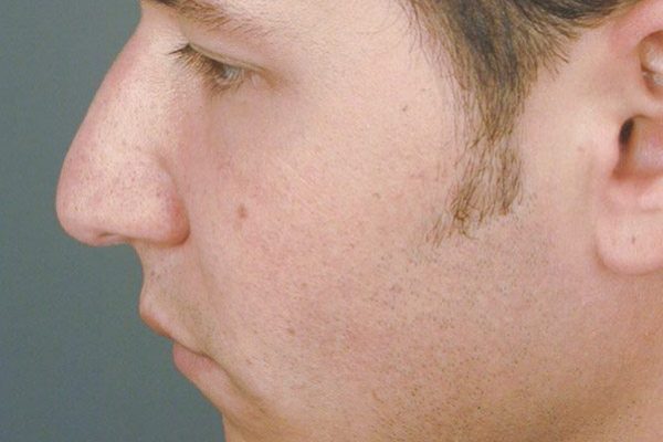 rhinoplasty-59