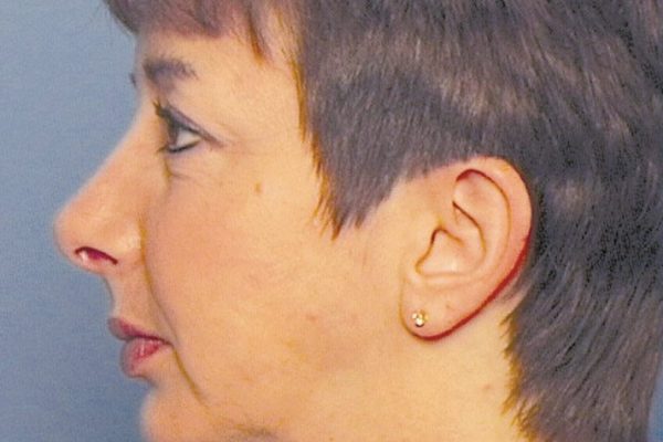 rhinoplasty-61