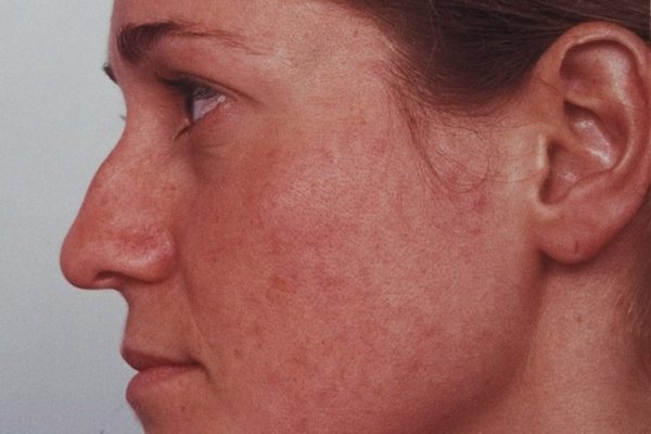 rhinoplasty-62