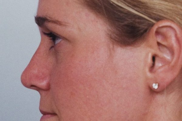 rhinoplasty-63