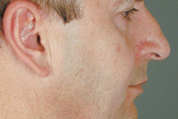 rhinoplasty-64