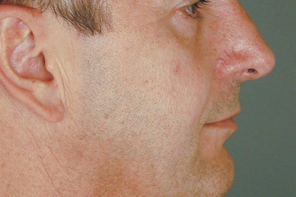 rhinoplasty-65
