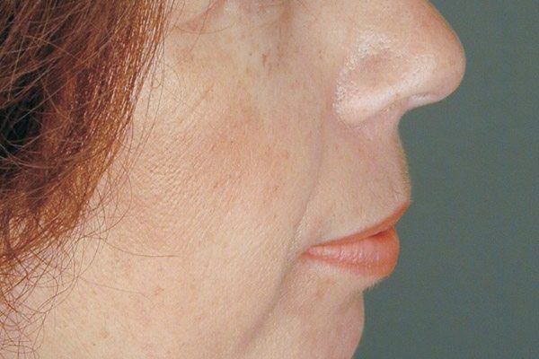 rhinoplasty-66