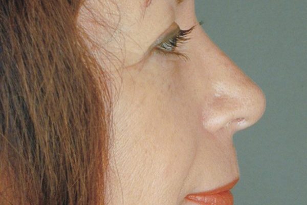 rhinoplasty-67
