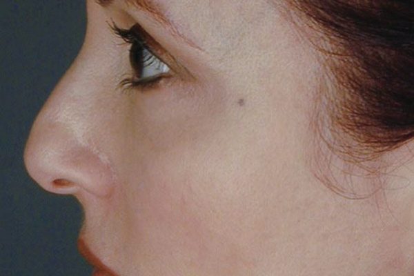 rhinoplasty-68