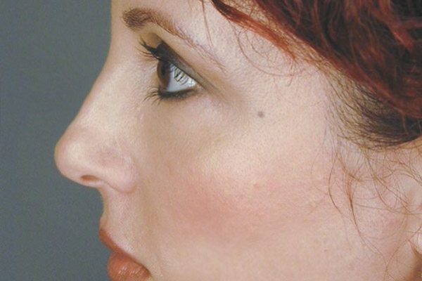 rhinoplasty-69