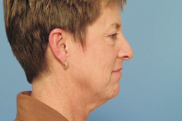 rhinoplasty-70
