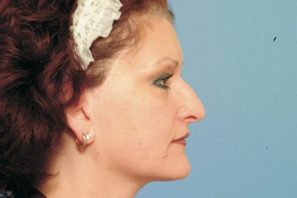 rhinoplasty-71