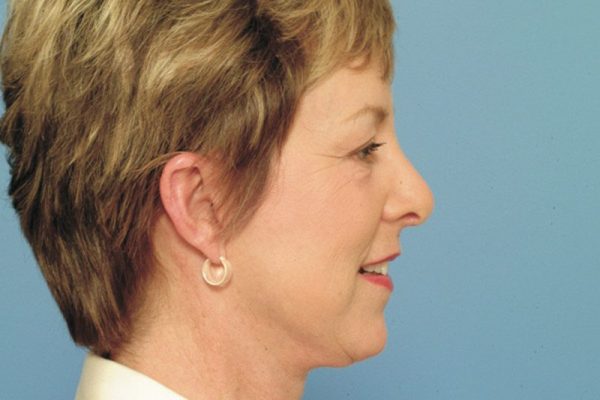 rhinoplasty-711