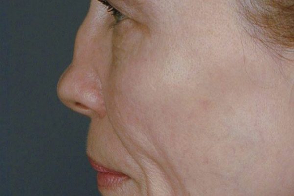 rhinoplasty-72