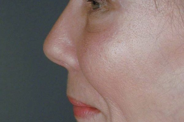 rhinoplasty-73