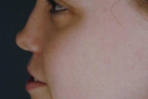 rhinoplasty-74