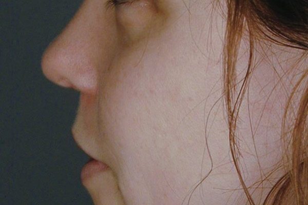 rhinoplasty-75
