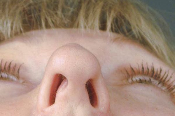 rhinoplasty-76