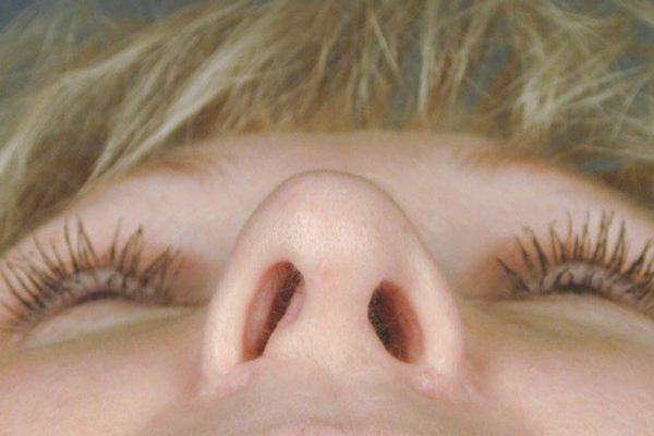 rhinoplasty-77