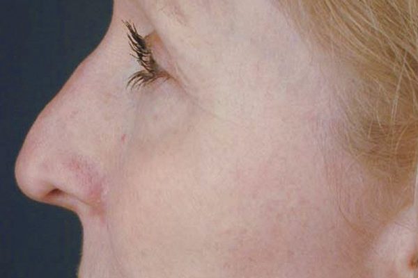 rhinoplasty-78