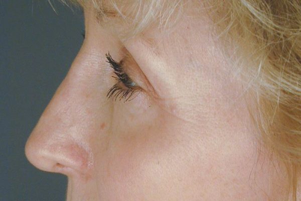 rhinoplasty-79