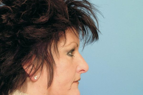 rhinoplasty-81