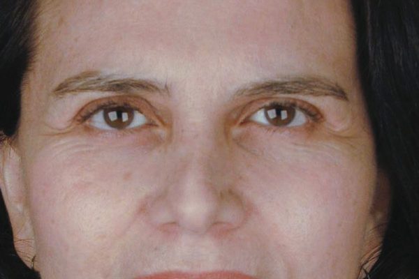 rhinoplasty-82