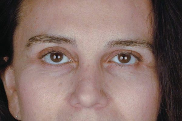 rhinoplasty-83
