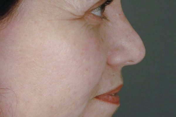 rhinoplasty-84