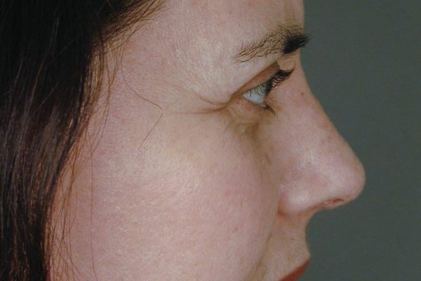 rhinoplasty-85