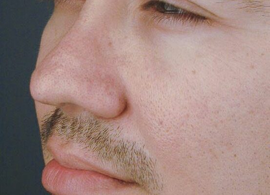 rhinoplasty-86
