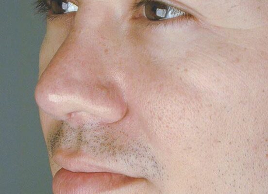 rhinoplasty-87